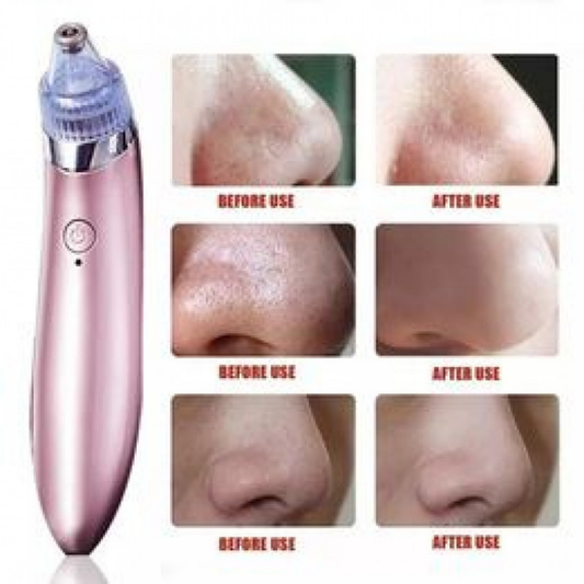 Beautiful Skin Expert 4 In 1 Black Head Remover (Good Quality)